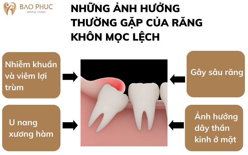 Những ảnh hưởng thường gặp của răng khôn mọc lệch